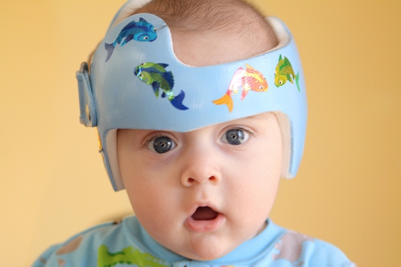Infant wearing a helmet for therapy, also known as cranial remolding therapy