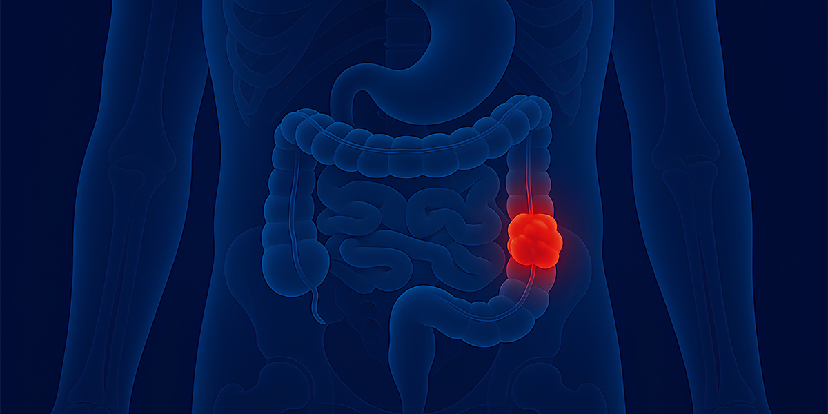 Sphincter Preservation